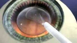 Staar Surgical Visian ICL Implantation [upl. by Ydnar]