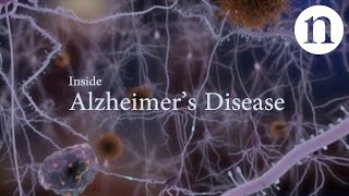 Inside Alzheimer’s disease [upl. by Lunn]