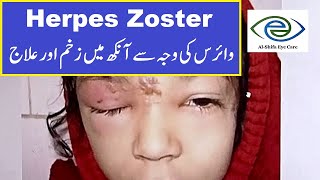 Herpes Zoster Ophthalmicus Symptoms and Treatment  UrduHindi [upl. by Lennon]