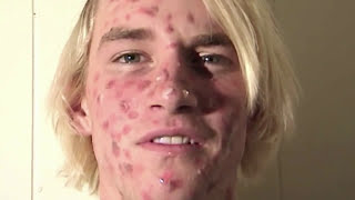 ZIT FACE GUY  PIMPLE ACNE EXPLOSION [upl. by Sidnak]