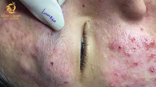 Treatment of acne tablets pustules and blackheads 360  Loan Nguyen [upl. by Joo]