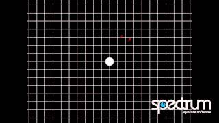 Clinical Tutorial  Foveal Grid [upl. by Manolo]